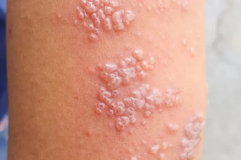 Shingles: Symptoms, Causes, and Treatments