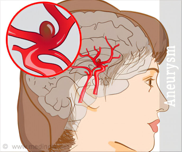 Aneurysm: Types, Cause, and Symptoms