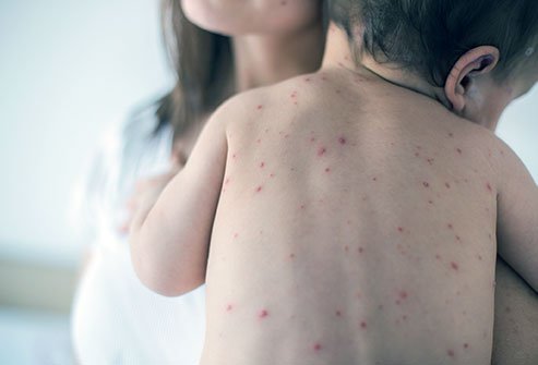 Chickenpox: Everything You Need To Know