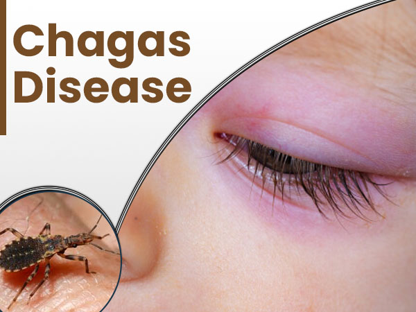Chagas Disease: Causes, Signs, and Symptoms