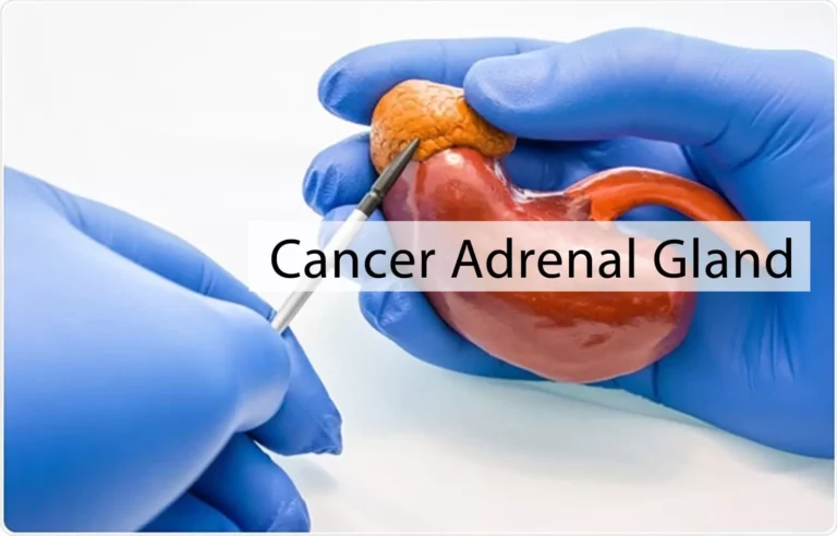 Adrenal Gland Cancer: Symptoms, and Causes