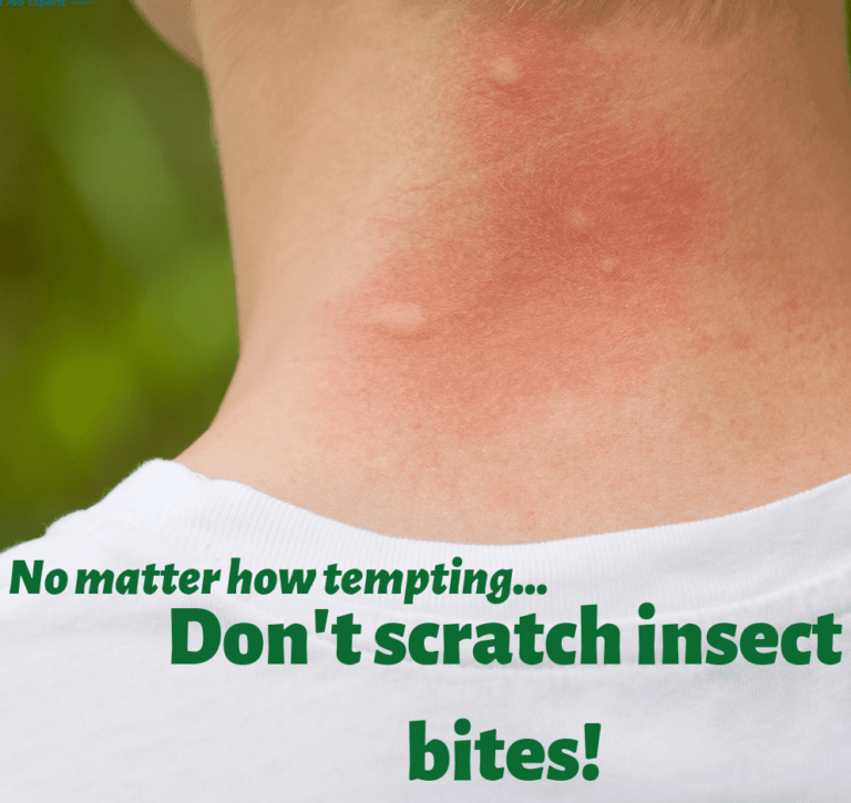 Insect Bites and Stings: Don’t scratch insect bites!