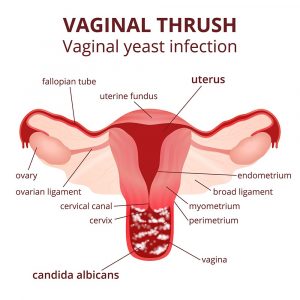 Vaginal Yeast Infection: Causes, & Symptoms