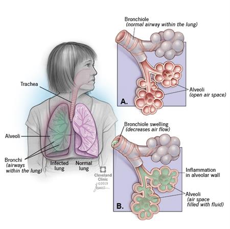 Pneumonia Symptoms and Diagnosis