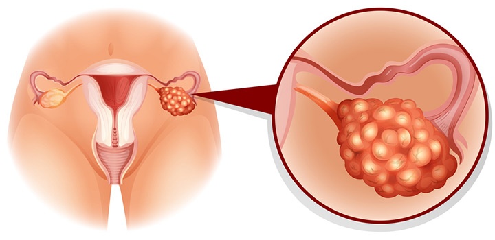 Polycystic Ovary Syndrome (PCOS)