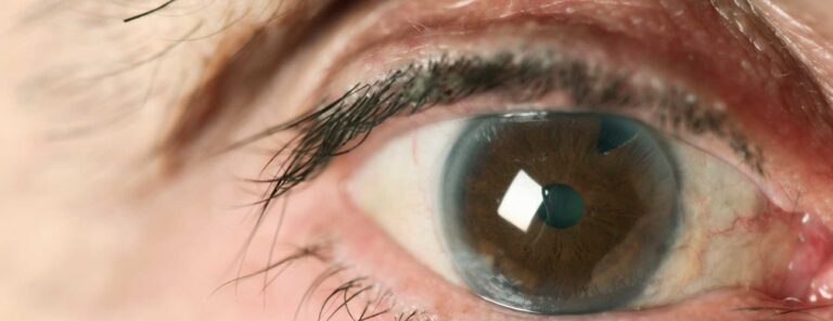 Cataracts: Learn More About Your Vision