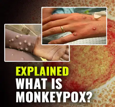 Monkeypox: What is it and how do you catch it?