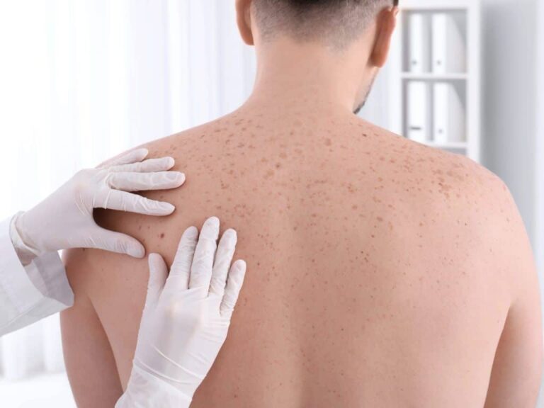 Skin Cancer: Symptoms and Factors