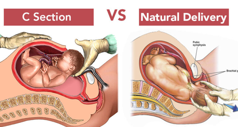 Normal Delivery and CS Delivery: The Comparison