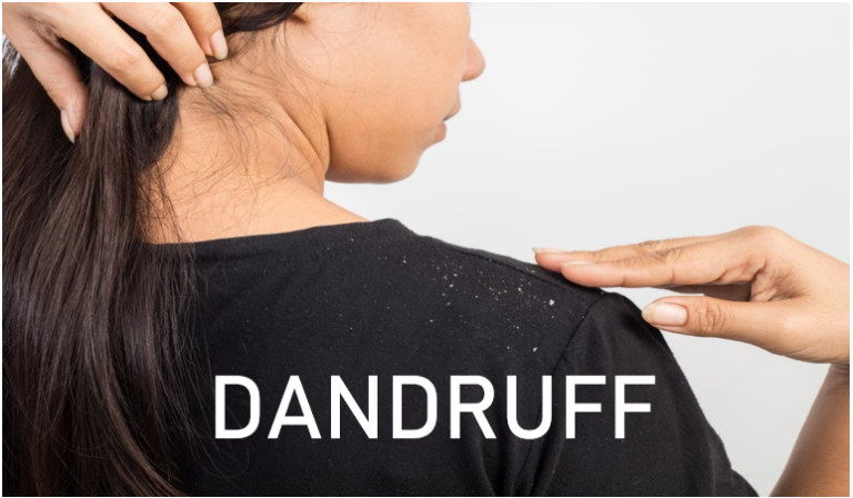 Dandruff- Symptoms, Causes, and Treatments