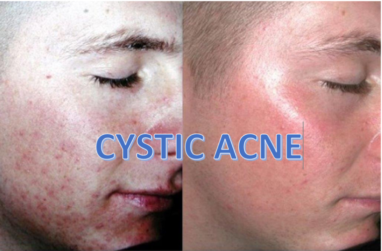 Cystic Acne: Causes, Symptoms, and Treatments
