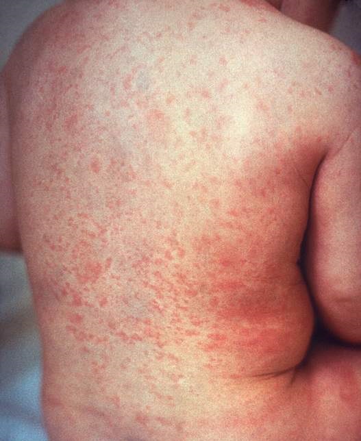 Rubella: Causes and Treatments
