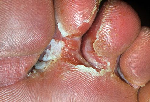 Athlete’s foot: Causes and Treatment