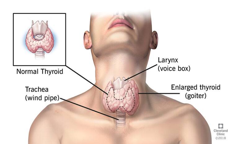 Goiter: What to Do If You Have It