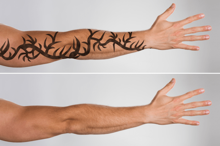Tattoo Removal: What to Know