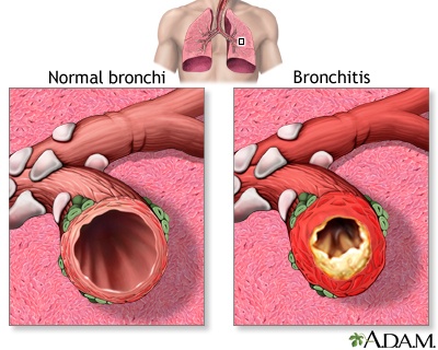 Acute Bronchitis: Causes and Symptoms