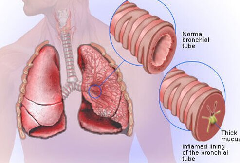 Bronchiectasis: What You Need To Know