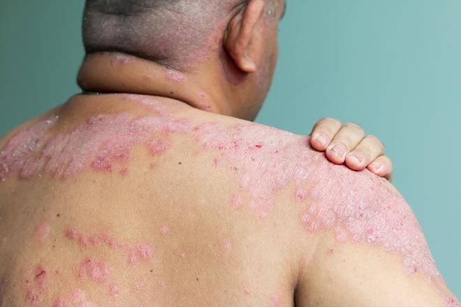 Psoriasis: Different Types, Causes and Treatments