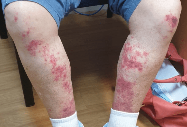 Vasculitis: More About This Blood Vessel Disease