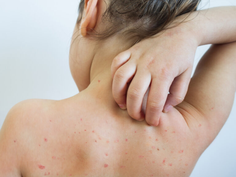 Measles: Causes, Symptoms and Treatment