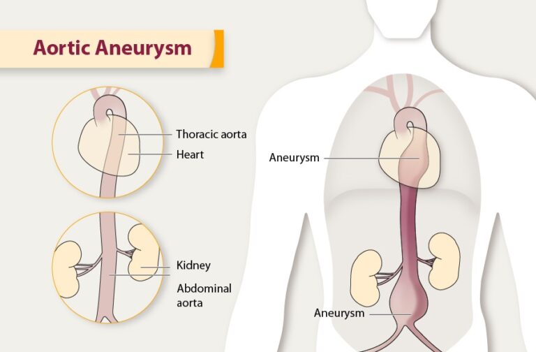 All About Aortic Aneurysm